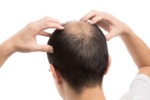頭皮マッサージのやりすぎは抜け毛を増やす